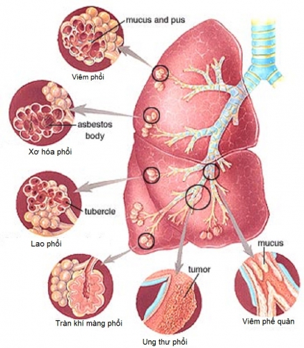 Hội chứng suy hô hấp: nguyên nhân, chẩn đoán, triệu chứng và cách phòng ngừa